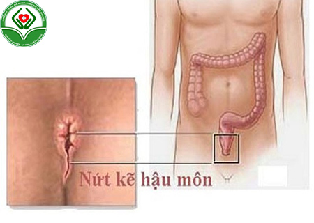 nguyên nhân bị bệnh mạch lươn