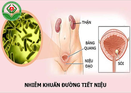 Bệnh nhiễm khuẩn tiết niệu là gì?