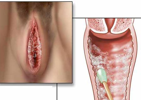 Nấm Candida có thể gây viêm âm đạo