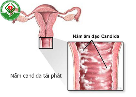 nấm candida tái phát