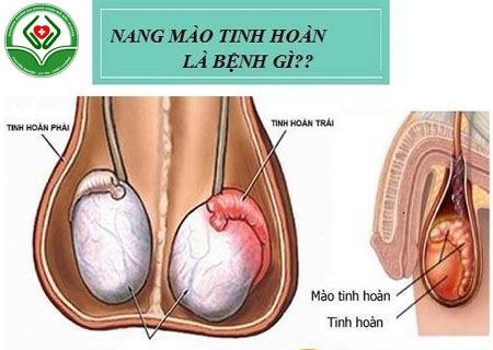 Nang mào tinh hoàn là bệnh gì?