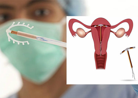 Vòng tránh thai sau khi được đặt vào cổ tử cung