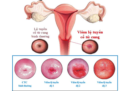 Viêm lộ tuyến cổ tử cung có 3 cấp độ